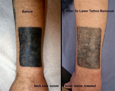 The number of treatments depends on the color of the ink, the size, and the skin type, as well as how big the tattoo is. Tattoo and PMU removal with laser. | Dark Rose Tattoo