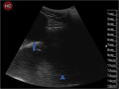 Managing A Seroma With Wireless Mobile Ultrasound Device Journal Of