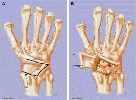 @article{calandruccio2001proximalrc, title={proximal row carpectomy}, author={j. Comparison of proximal row carpectomy and midcarpal ...