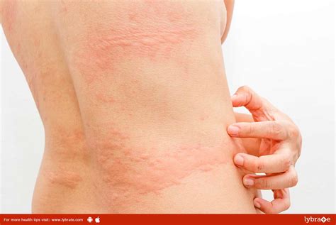 Scabies How To Diagnose It Health And Fitness Information Wellness