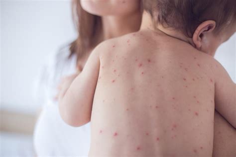 Measles Causes Symptoms And Treatment
