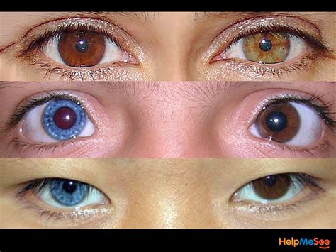 The Condition Where Someone Is Born With Two Different Colored Eyes Is Called Heterochromia