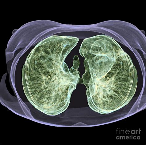 Healthy Lungs 3d Ct Scan Photograph By Zephyr