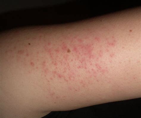 Scaly Itchy Red Bumps On Arms