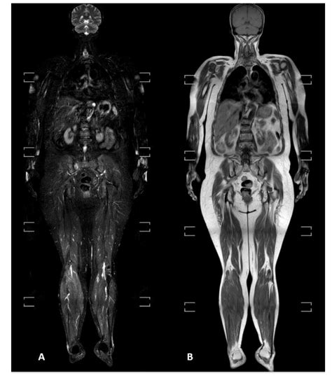 Diagnostics Free Full Text Diagnostic Value Of Whole Body Mri Short