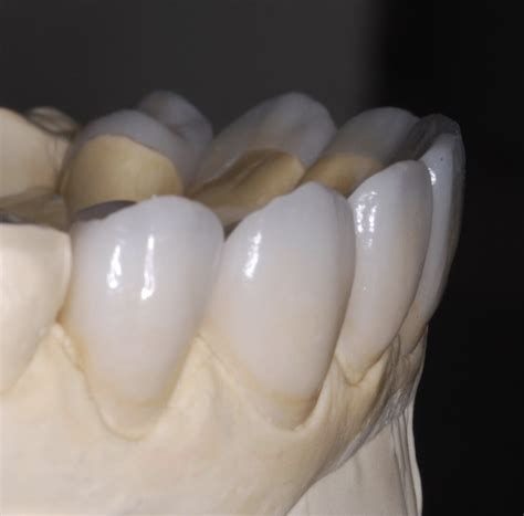 The lifespan of veneers made out of porcelain is unrivaled. How Long Do Veneers Last - City Dental