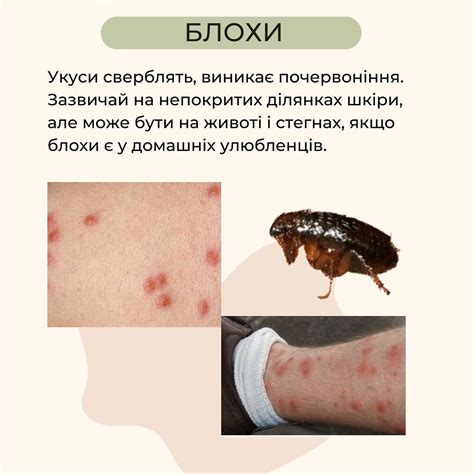 Симптомы укуса комара блох пчел как их распознать РБК Украина