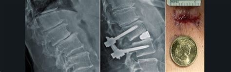 Minimally Invasive Spine Surgery Neurosurgery