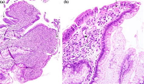 A Antral Mucosal Biopsy Hematoxylin And Eosin H E Staining Low