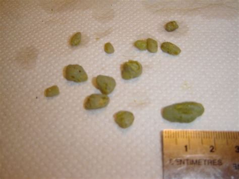 1.5 cm equals 0.59 inches, or there are 0.59 inches in 1.5 centimeters. 1.5 cm gallstone On CureZone Image Gallery