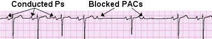 Blocked Premature Atrial Contractions