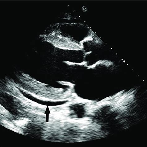 Echocardiogram Parasternal Long Axis View Plax View Showing Normal