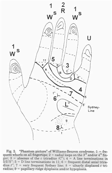 It causes many developmental problems. Hand chart for Williams syndrome, source: A. Rodewald ...
