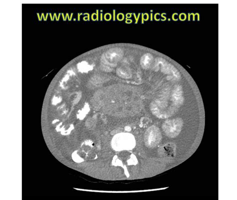Unknown Case 21 Abdominal Pain Ct Of The Abdomen And Pelvis