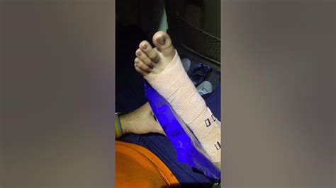 Mumbiker Nikhils Wife Shanice Legs Got Fractured Mumbiker Nikhil