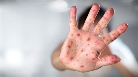 Measles Warning For European Travel Over Festive Period Bbc News