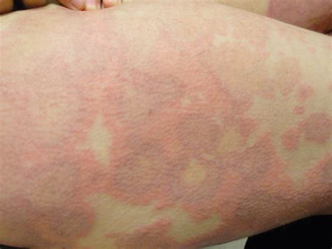 How May Coronavirus Symptoms Covid 19 Manifest On The Skin Skinive