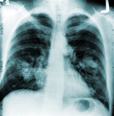 Lung X Ray Show Cancer Considering Longer Chemotherapy