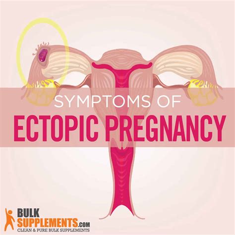 Ectopic Pregnancy Characteristics Causes Treatment