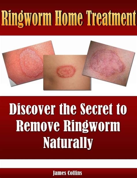 Ringworm Home Treatment Discover The Secret To Remove Ringworm