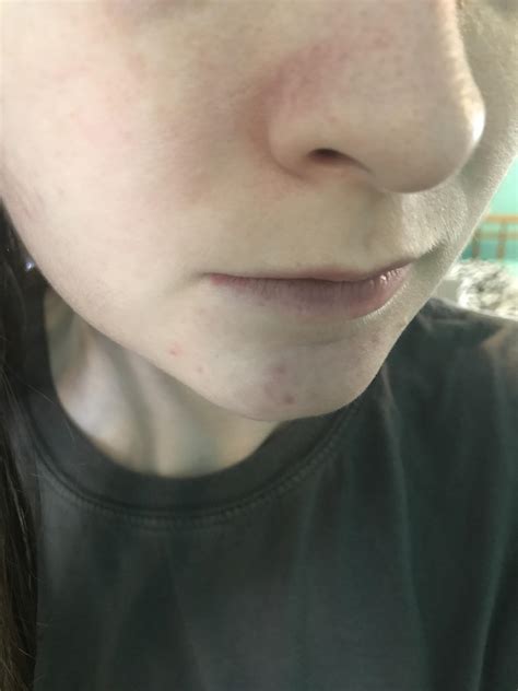 Skin Concerns Advice For Redness Around My Nose Rskincareaddiction