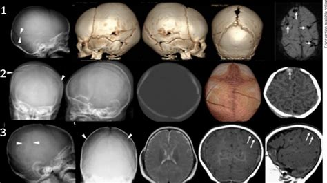 Bilateral Parietal Skull Fractures In Infants Attributable To