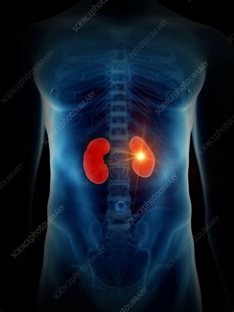 Illustration Of A Painful Kidney Stock Image F0234859 Science
