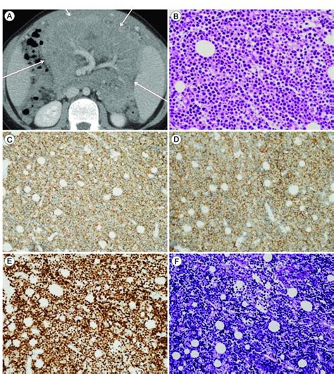 Burkitts Lymphoma Bl With Latent Ebv Infection Abdominopelvic