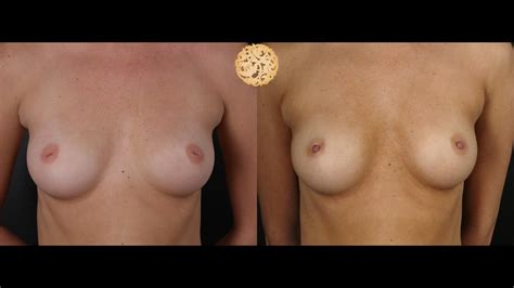 Inverted Nipple Correction Gallery Plastic Surgery