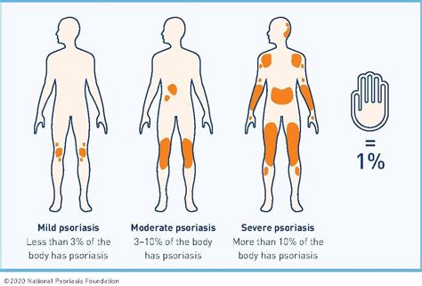 Why Treat Psoriasis National Psoriasis Foundation