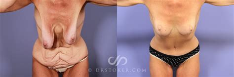 Breast Reduction For Women Before And After Pictures Case Los