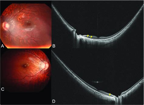 Images Of Highly Myopic Eyes With Peripapillary Diffuse Atrophy But
