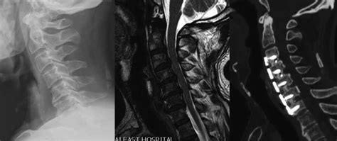 Figure A Year Old Man With Cervical Spondylotic Myelopathy A Poor