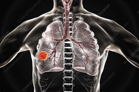 Lung Cancer Illustration Stock Image F0221942 Science Photo Library