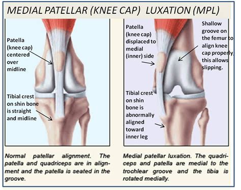 Medial Patella Luxation Mpl Explanation And Anatomical Comparison Normal On The Left And Mpl