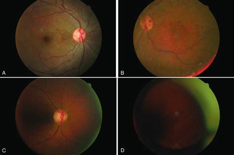Representative Color Fundus Images From The Excellent A Good B