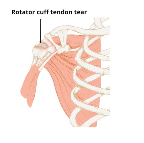 Rotator Cuff Tear Circle Integrated Care