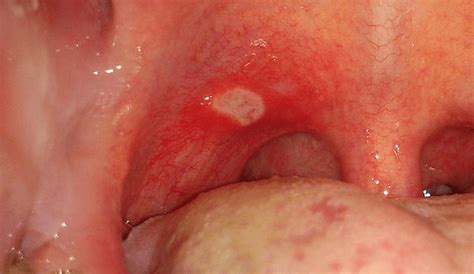 White Spots On Back Of Throat Meaning Cancer No Pain Std Strep