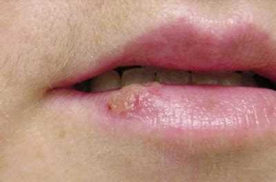 Both types of herpes simplex virus produce 2 kinds of infections: Vesicle on the lip after intense sun exposure - The ...