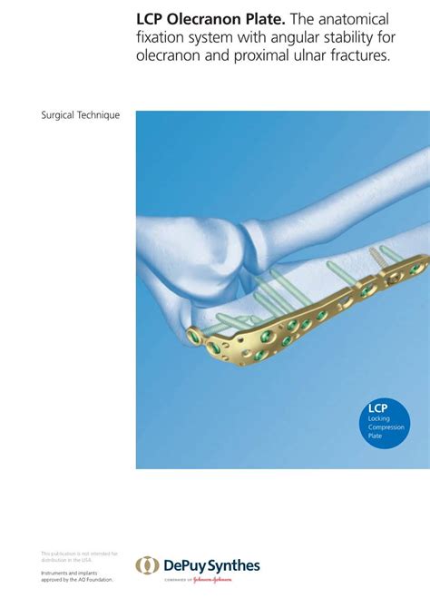 Lcp Olecranon Plate The Anatomical Fixation System With Angular