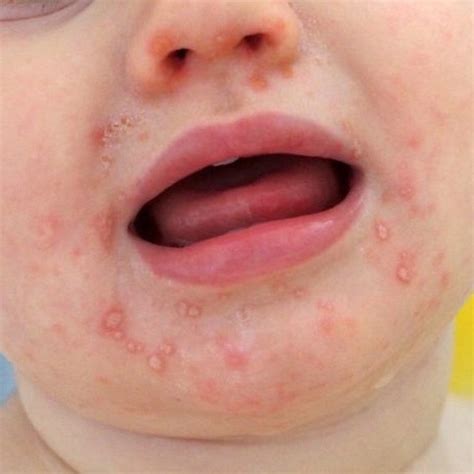 Tips To Prevent Hand Foot And Mouth Disease From Hmc Marhaba L Qatar