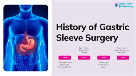 The History Of Gastric Sleeve Surgery Vertical Sleeve Gastrectomy