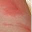 Skin Infection Pictures And Treatments