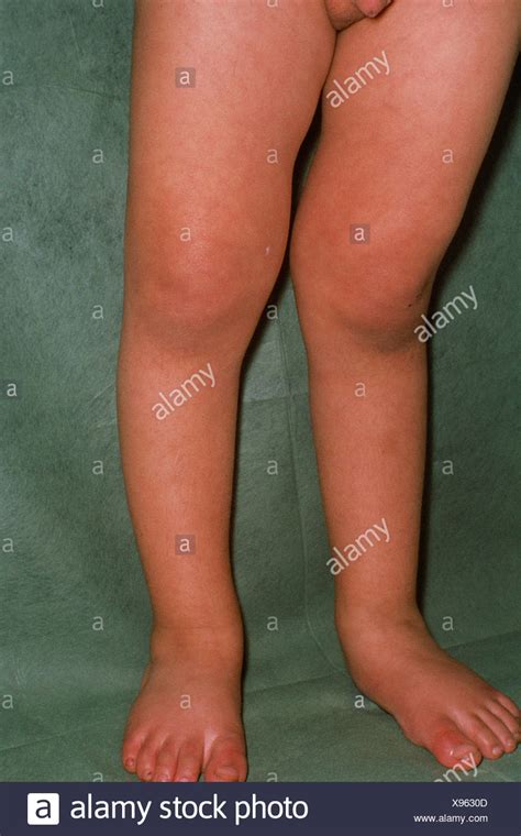 Rickets Child Stock Photos And Rickets Child Stock Images Alamy