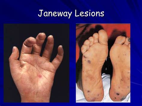 Janeway Lesions Sign Of Infective Endocarditis Microabscesses Caused My Xxx Hot Girl