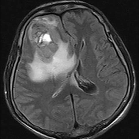 Brain Magnetic Resonance Imaging Metastatic Lesion With A