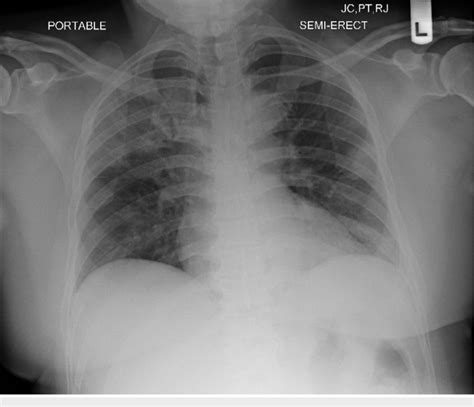 Chest X Ray Day 1 Revealed Right Upper Lobe And Bilateral Lower Lobe