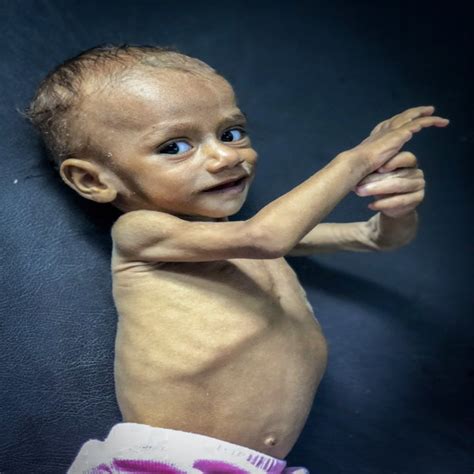 This Child Was Treated For Malnutrition Months Later He Might Still Die