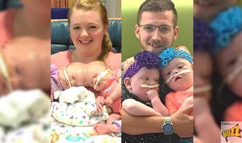 Conjoined Twins Who Survived Risky 11 Hour Surgery Are Going Home After 485 Days