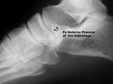 Osteochondral Lesions of the Talus and Occult Fractures of ...